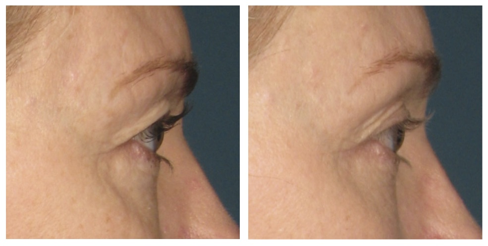 Before and after of Ultherapy at Accent Aesthetics in Galloway New Jersey