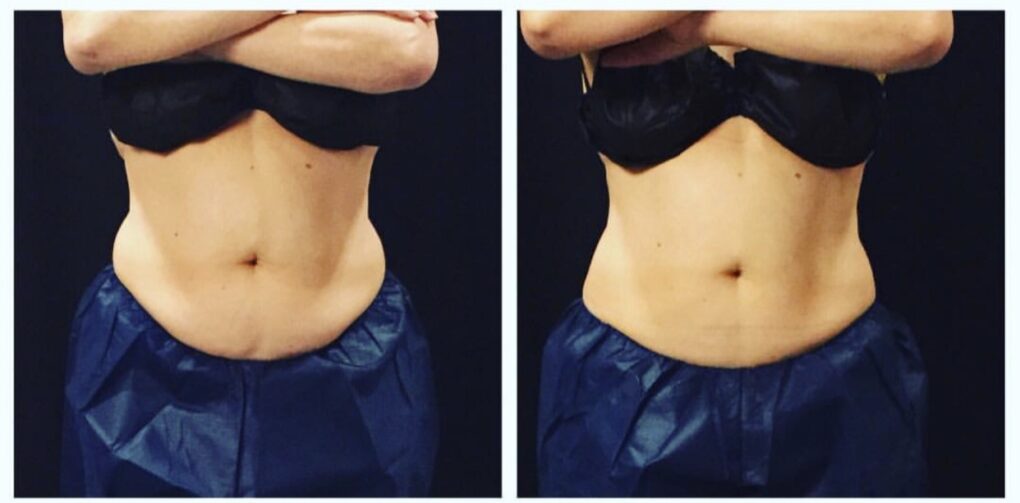 Coolsculpting Before and After Photos