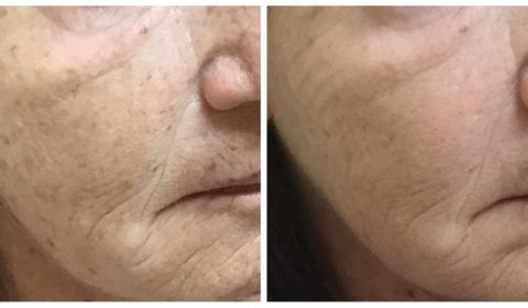 Chemical Peel Before & After Photo